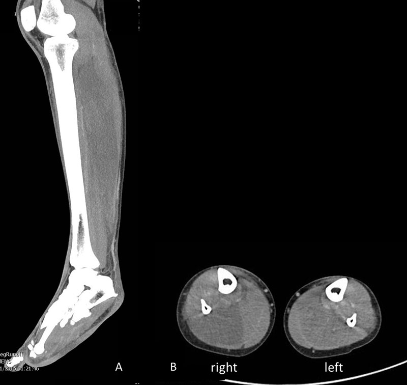 Kimber T, et al  Fashion victim: rhabdomyolysis and bilateral peroneal and tibial neuropathies as a result of squatting in ‘skinny’ jeans Journal of Neurology Neurosurgery & Psychiatry doi 10.1136/jnnp-2015-310628（Courtesy of BMJ）